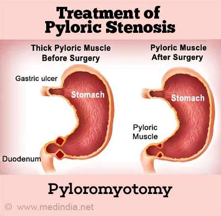 Treatment of pyloric stenosis