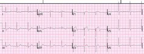 Dr. Smith's ECG Blog: A 53 year old with chest pressure has a ...