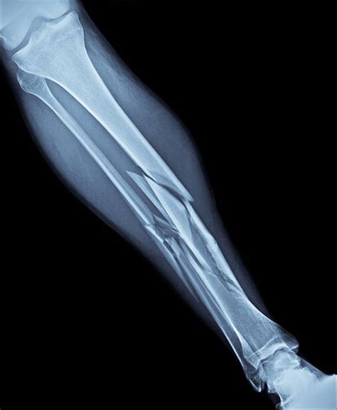 280+ Broken Leg Xray Stock Photos, Pictures & Royalty-Free Images - iStock