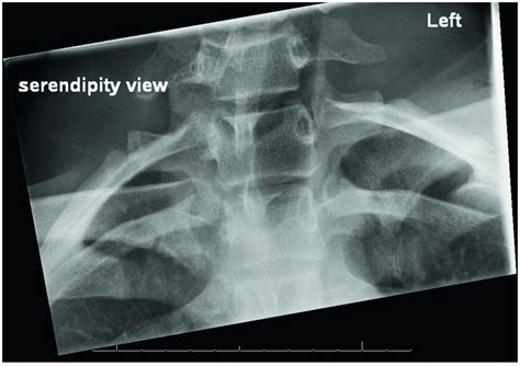 Chapter 1 – Shoulder | Musculoskeletal Key