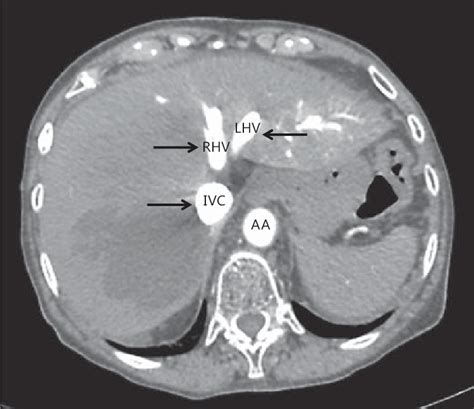 Abdominal Aorta And Ivc