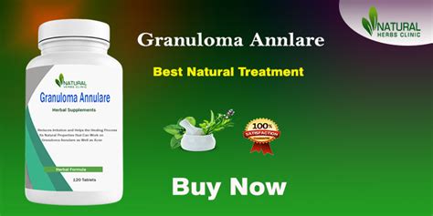 Read How I Get Natural Treatment for Granuloma Annulare