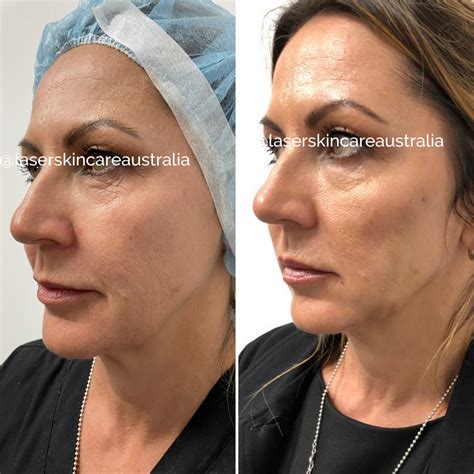 Thread Lift Procedure - Laser Skin Care