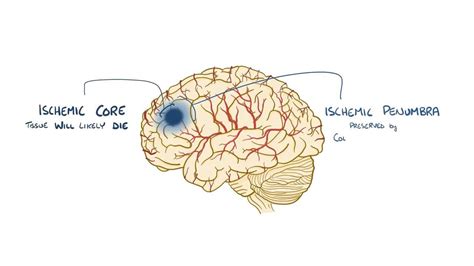 Ischemic stroke: Video, Anatomy, Definition & Function | Osmosis