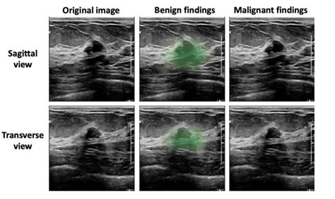 Improving Breast Cancer Detection in Ultrasound Imaging Using AI ...