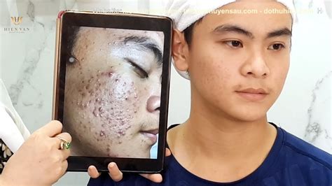 Review Client after Having finished treatment process at Hien Van Spa-381-Trung Hiếu - YouTube