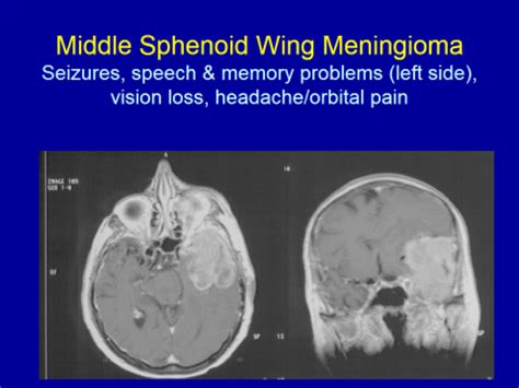 Clinical Presentation & Radiographic Appearance (by location) - Valley Neurosurgical Institute