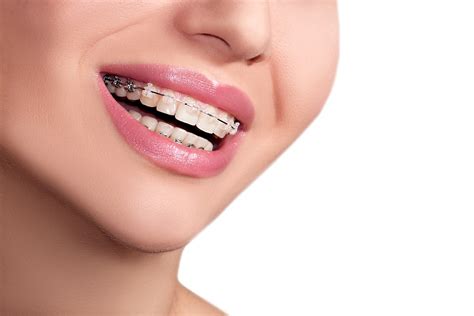 Dental Clear Braces in Houston, TX | Houston Precise Dental Care