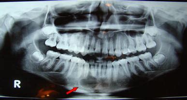 Traumatic Bone Cyst of Mandible | SpringerLink