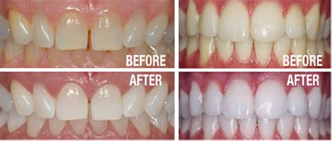 NOVA Dental | Cosmetic - What is Teeth Whitening?