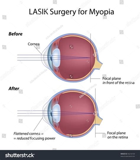 Lasik Eye Surgery For Myopia Stock Vector Illustration 94216159 : Shutterstock