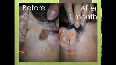 Natural treatment for seborrheic keratosis before and after photos - YouTube