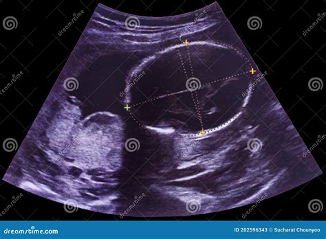 Ultrasound of Baby in Mother`s Womb Stock Image - Image of pregnancy, womb: 202596343