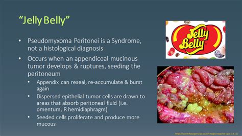 Pseudomyxoma Peritonei (AKA Jelly Belly) | SCVMC IM Chief Resident Blog