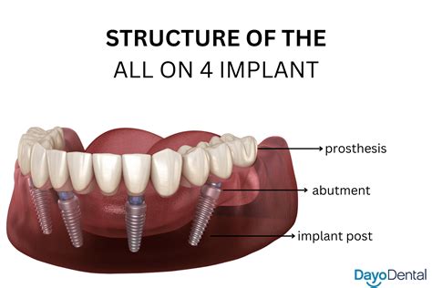 Snap on Dentures vs All on 4 Dental Implants: A Comprehensive Guide