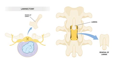 Laminectomy and Discectomy - SpineCare Singapore