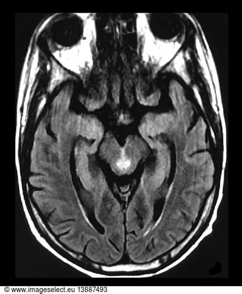 Wernicke's Encephalopathy on MRI Wernicke's Encephalopathy on MRI ...