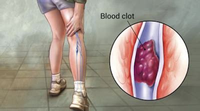 Blood Clot in Leg: Signs And Symptoms You Shouldn’t Ignore