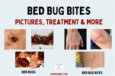 Bed Bug Bites: Pictures, Symptoms, Treatment & Prevention