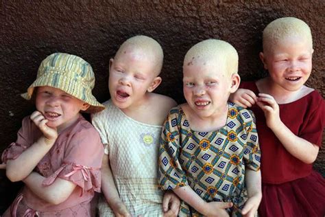 The international attention in favor of people with Albinism in Africa - Le portail de référence ...