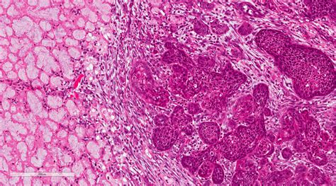 Necrotising sialometaplasia. Coagulative necrosis of acini, hyperplasia ...