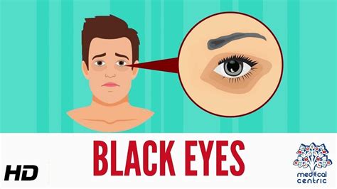 Black Eye, Causes, Signs and Symptoms, Diagnosis and Treatment - YouTube