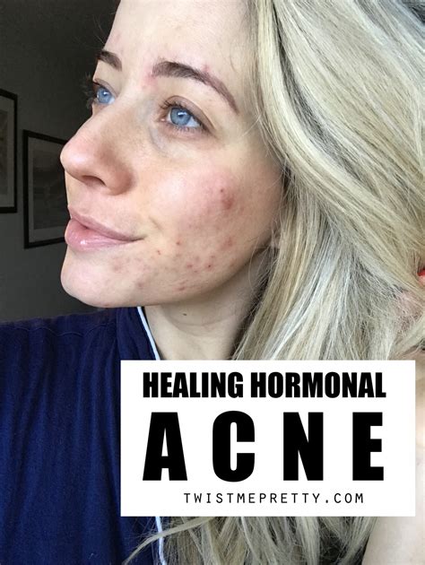 How To Clear Up Hormonal Acne + My Journey - Twist Me Pretty