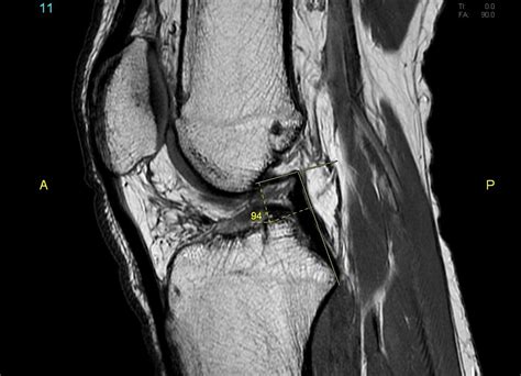 Signs of ACL tear on MRI- Resident's Corner - Sumer's Radiology Blog