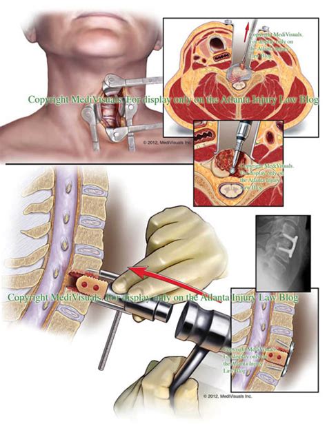 slipped disc jaw surgery - Luke Bond