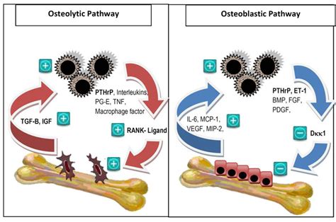 JCM | Free Full-Text | Treatment and Prevention of Bone Metastases from Breast Cancer: A ...