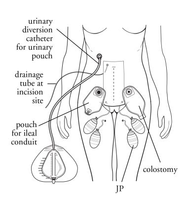 Total Pelvic Exenteration | Memorial Sloan Kettering Cancer Center