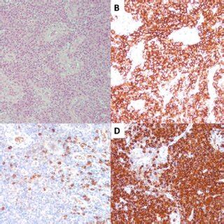 Pathology findings from cervical biopsy. There are diffuse sheets of ...