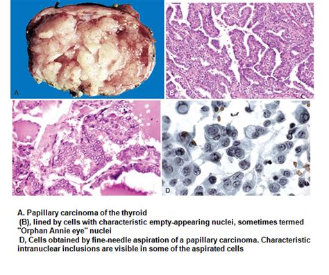 MBBS Medicine (Humanity First): Papillary Carcinoma.