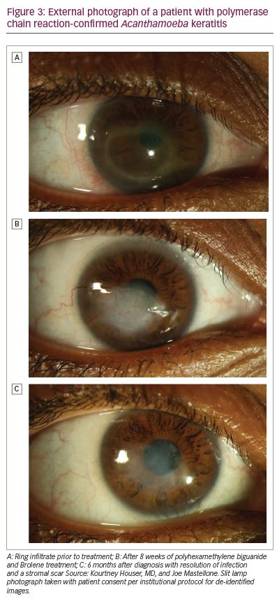 Acanthamoeba Corneal Ulcer