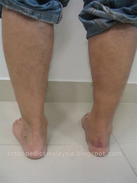 Gastrocnemius Muscle Tear (Calf Tear) | The Orthopedics Malaysia blog