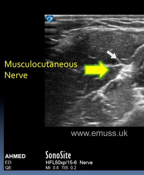 Emergency Medicine Ultrasound Society (EMUSS) - Ultrasound Guided Peripheral Nerve Block Course