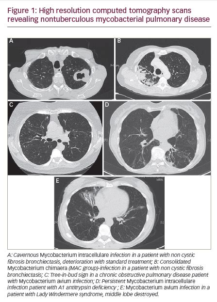 Mac Lung Disease Progression - Captions Update Trendy