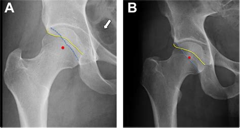 Arthroscopic Treatment of Acetabular Retroversion With Acetabuloplasty ...