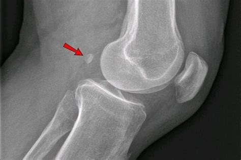 Scientists say tiny fabella knee bone could be linked to arthritis