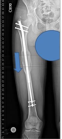 Limb Lengthening Surgery | HSS Orthopedics Ranked #1 in US