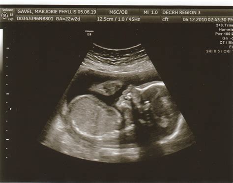 Carrying A Rainbow: 22 weeks + 2 days...Ultrasound with the specialist and first appointment ...