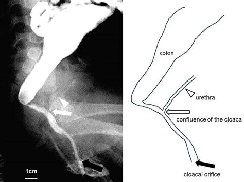 Fistulography and schema of the cloaca, 7 months of age. The common... | Download Scientific Diagram