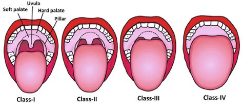 Difficult laryngoscopy and intubation: Modified Mallampati... | Download Scientific Diagram