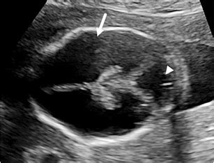 Hydranencephaly Ultrasound