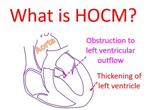 What is HOCM? - All About Heart And Blood Vessels