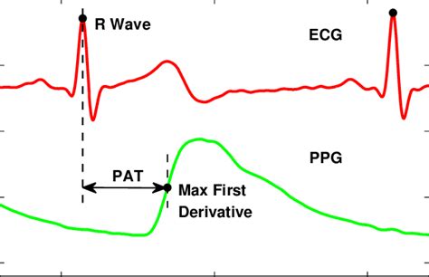 Graphical description of finding the R-wave peaks of ECG signals and... | Download Scientific ...