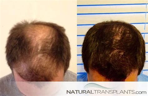 bosley hair transplant locations - Jefferey Duong