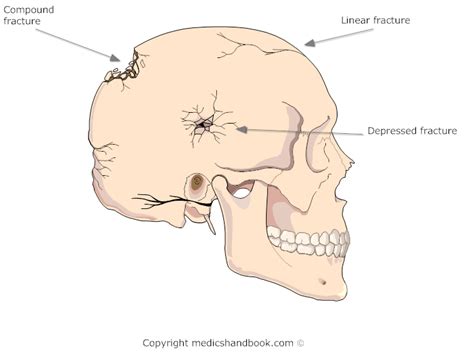 Types Of Skull Fracture - Fracture Treatment