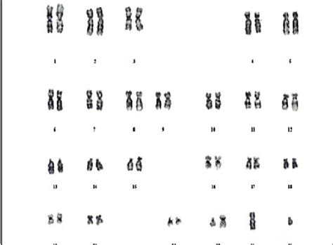 Karyogram of a Down Syndrome (DS) male patient showing translocation,... | Download Scientific ...