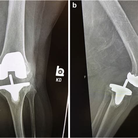 Intraoperative photograph of left total knee arthroplasty with the... | Download Scientific Diagram